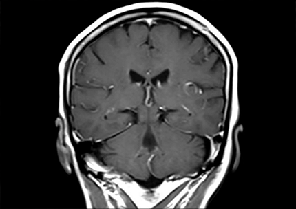 MRI（磁気共鳴画像）