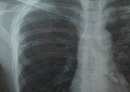 X線（X-Ray）